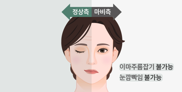 stroke 말초성 안면마비